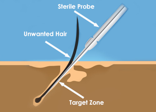 electrolysis probe